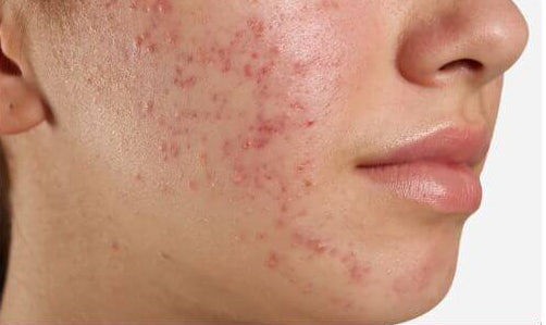 Jerawat Naik Balik